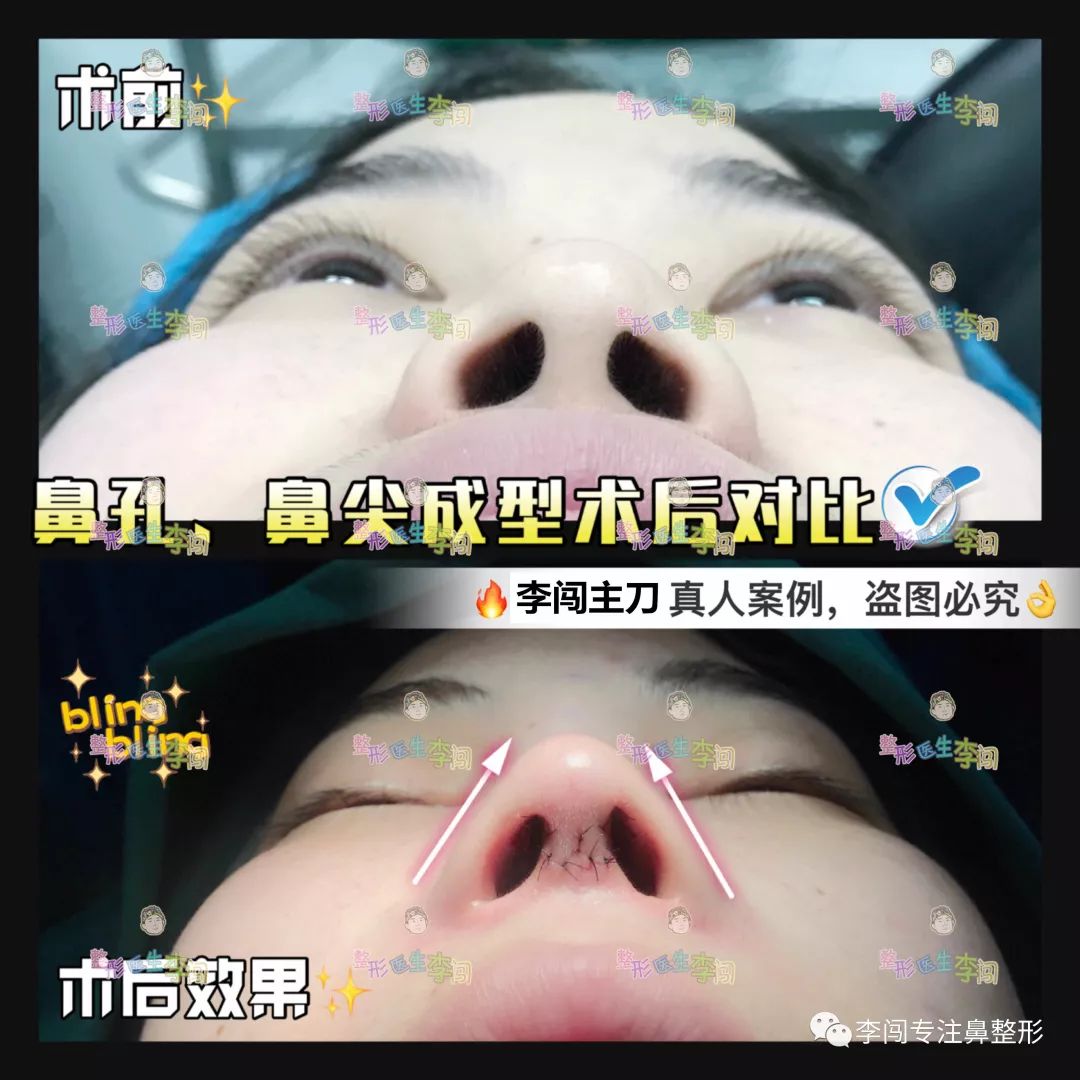 什么样的鼻型才是最好看的鼻型-徐荣阳副主任医师-爱问医生