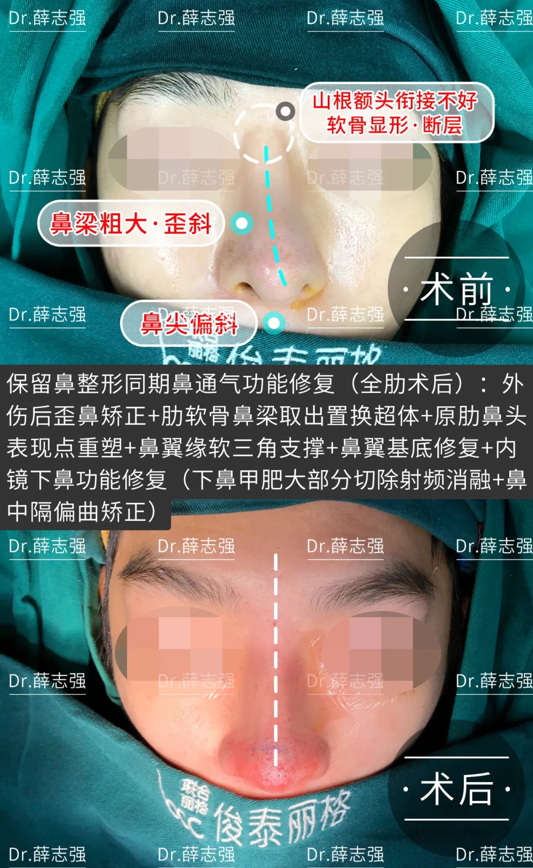 案例 鼻内镜辅助下 鼻外形和鼻功能 同期修复案例 整形医生薛志强