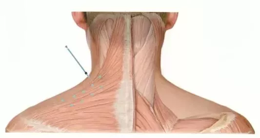 瘦肩针注射部位图解图片