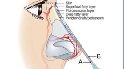 双平面注射隆鼻：微量肿胀液预处理4步法