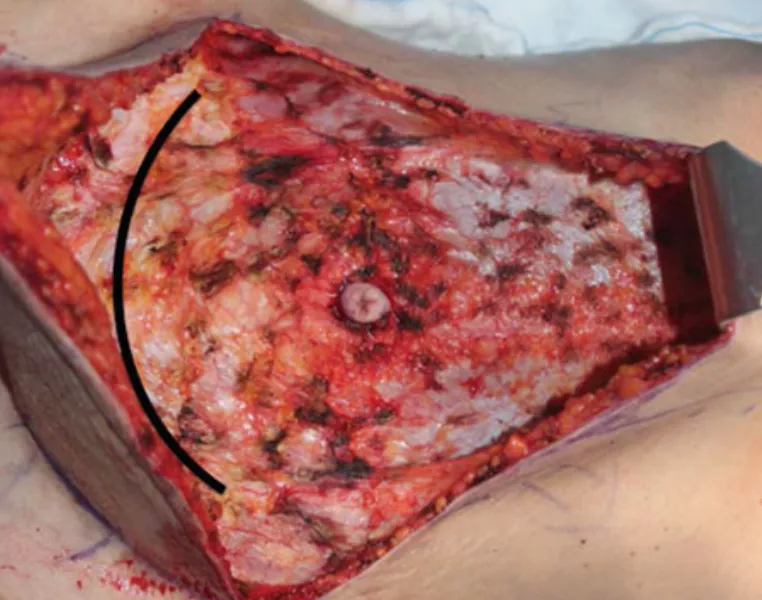 腹壁整形环切疤痕图片图片